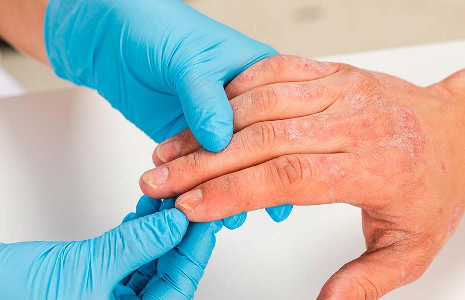 dermatitis en las manos